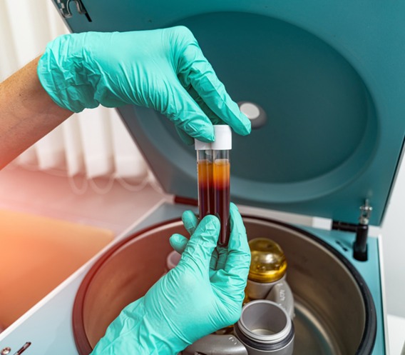 Medical professional holding syringe tube of plasma